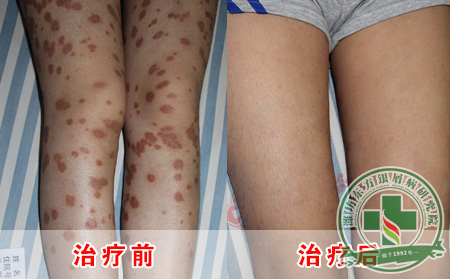 治疗银屑的好方法