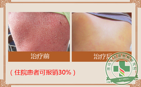 阿维A胶囊