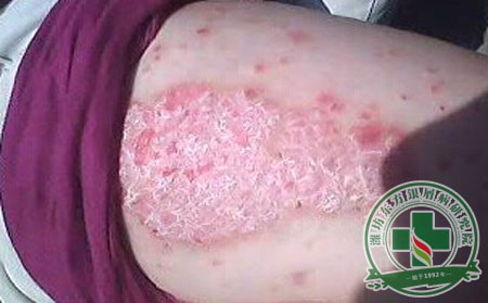 济南银屑病医院银屑病病人佳皮肤护理方式