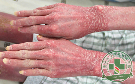 儿童银屑病常见病因介绍