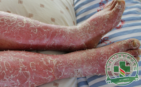 脓疱型银屑病患者秋季日常注意事项有哪些?