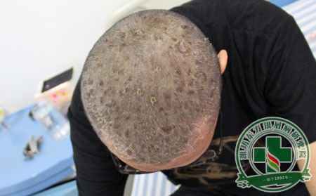 牛皮癣治疗好方法头部牛皮癣患者要怎样洗头可以