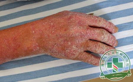 脓疱型银屑病临床分型及症状介绍