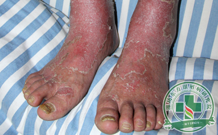 浅谈脓疱型牛皮癣诱发因素