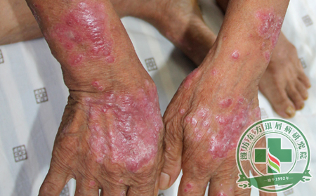 浅谈脓疱型银屑病自我诊断方法