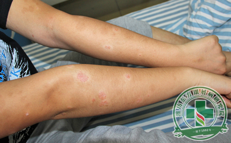 大寒时节，银屑病患者应该怎样养生