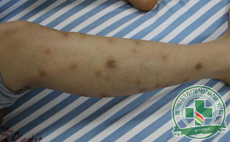 脓疱型银屑病怎么治疗效果好