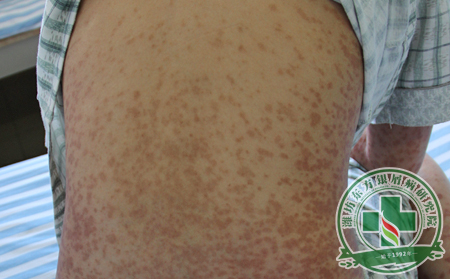 潍坊银屑病医院如何更好的对待银屑病