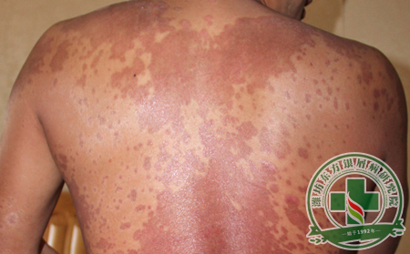 运动过后牛皮癣患者要注意什么?