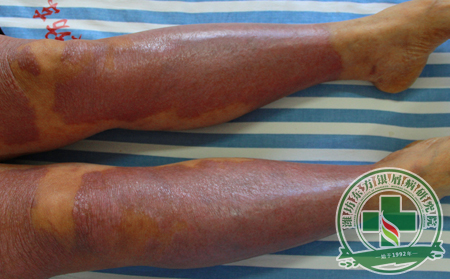 牛皮癣对生活造成哪些影响呢?