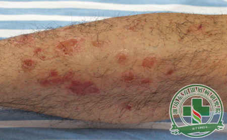 牛皮癣患者关注：夏季哪些植物可以有效驱蚊