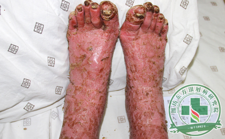 患者介绍！银屑病护理我们有一套