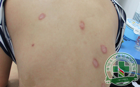 银屑病可以转的症状表现有哪些