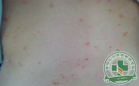 如何控制牛皮癣患者的病情