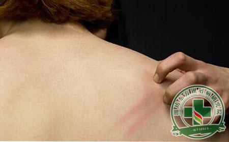 牛皮癣皮肤痒要怎么护理-银屑病医院