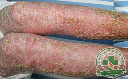 脓疱型银屑病的症状有哪些呢？