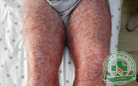 病因不同导致银屑病症状不同