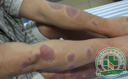 银屑病应怎样进行治疗？