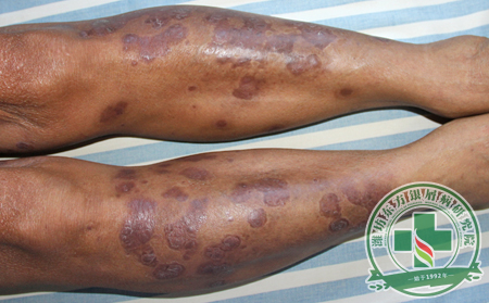 牛皮癣有哪些形态和变化