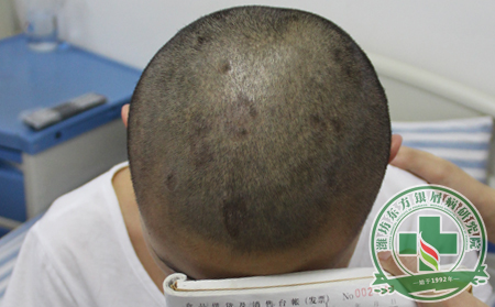 银屑病不是叫牛皮癣，那属于“癣”吗？