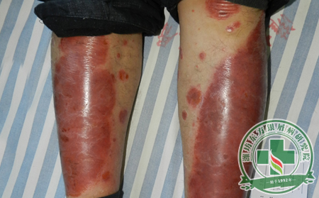 反复出现在患者身边的银屑病病因