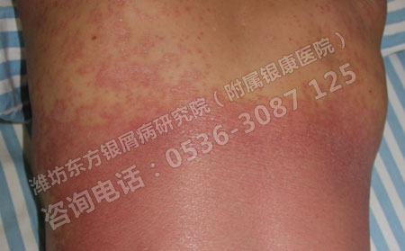 红皮型银屑病怎么治好的快