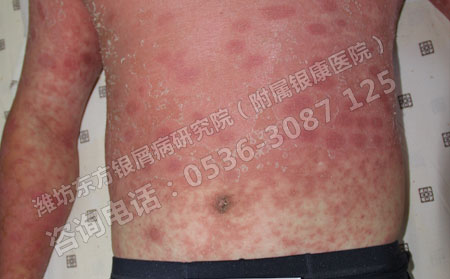 银屑病患者应该怎么护理自己的身体呢
