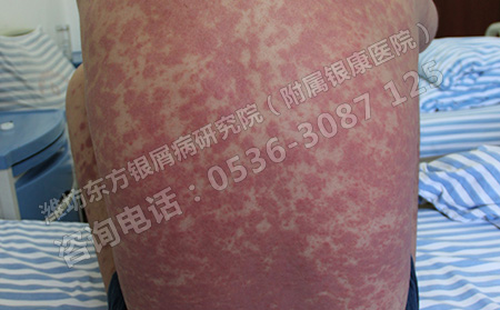 什么样的化妆品会诱发银屑病