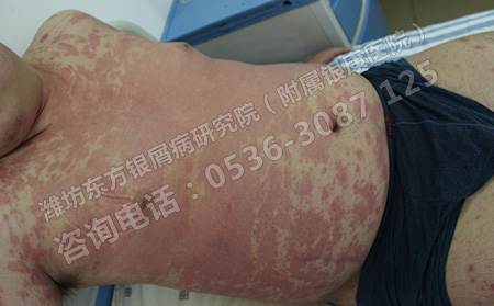 银屑病到底应该怎么治才能可以