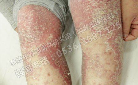 银屑病患者的饮食治疗方法