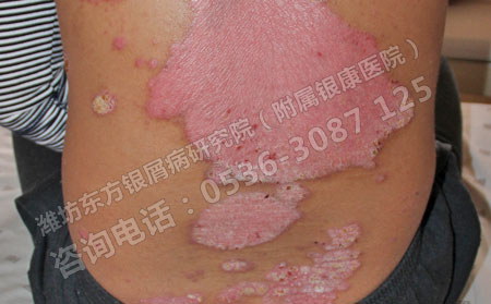 要想治好银屑病需要怎样做