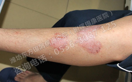 潍坊银屑病患者刚患病的时候该怎么治疗