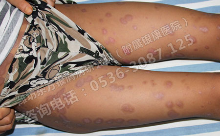 春发型银屑病患者要怎样护理