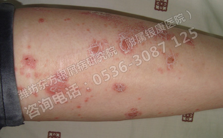 解析春季牛皮癣的一些相关防治知识