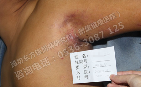 银屑病不严重怎么治疗好