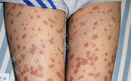 潍坊银屑病患者春季复发怎么治疗好