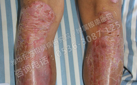 男性银屑病患者生活中要注意哪些方面的预防