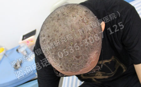 治牛皮屑的可以方法