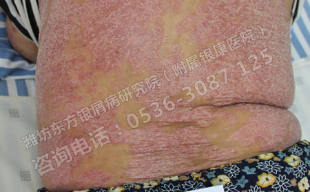 为什银屑病患者的病情总是复发?