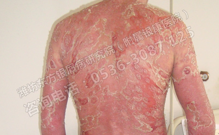 春季银屑病怎么进行治疗呢
