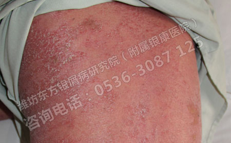 引起银屑病的原因您都了解吗？