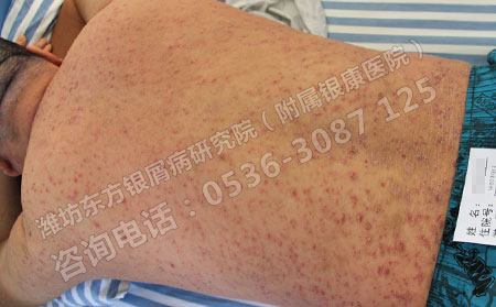 银屑病怎么治疗效果比较好呢？