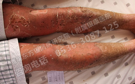 银屑病患者要了解的银屑病治疗常识