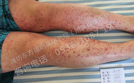 银屑病要怎么治疗不容易复发