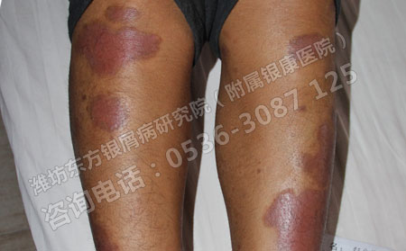 银屑病要怎么治疗才更有效果呢