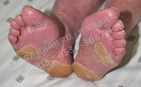 银屑病会对患者造成哪些危害呢