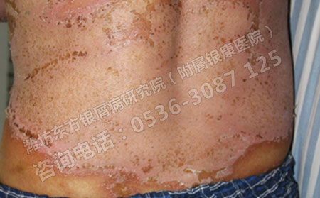 潍坊治疗银屑病要多少钱