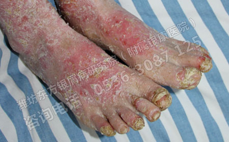 为何有些患者的银屑病越治疗越严重呢？