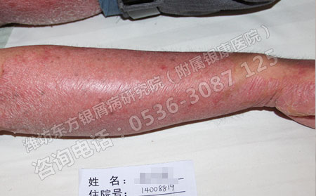 银屑病难治疗有哪些需要患者注意的