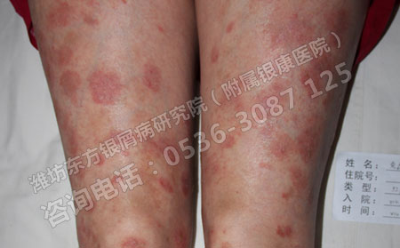 银屑病难治需要患者怎样辅助治疗